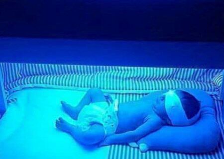 علت زردی نوزادان و راه‌های درمان آن