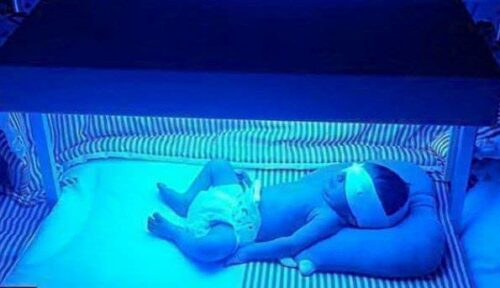 علت زردی نوزادان و راه‌های درمان آن