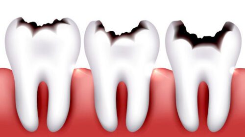 عوامل و راه‌های پیشگیری از پوسیدگی دندان‌ها