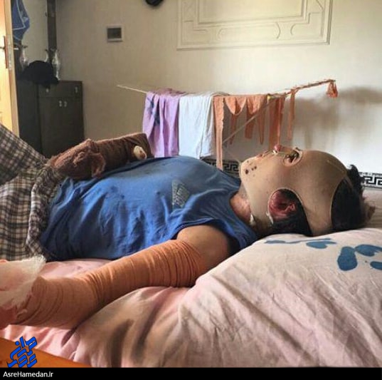 مزد حمید؛ آوار بی مهری مسئولان، بر سر قهرمان تویسرکان/آتش جسم حمید را سوزاند و کمیته امداد دلش را/ استاندارد  همدان از جوان فداکار تویسرکانی دلجویی نمی کند؟!